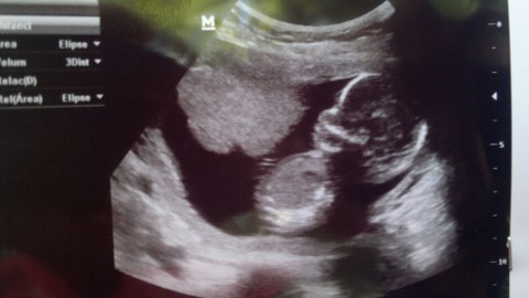 Estudio científico encuentra mejor salud materna con leyes de aborto menos permisivas